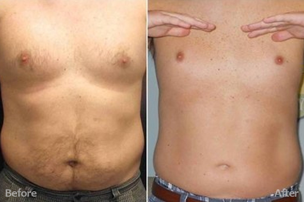 Before and after body comparison highlighting visible inch loss 