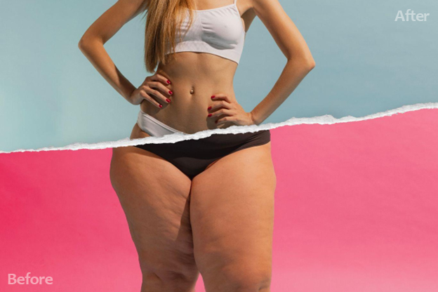 Body contouring results showing changes in fat distribution after treatment